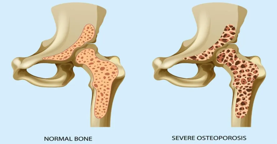 Jangan Tunggu Tulang Patah untuk Cek Osteoporosis