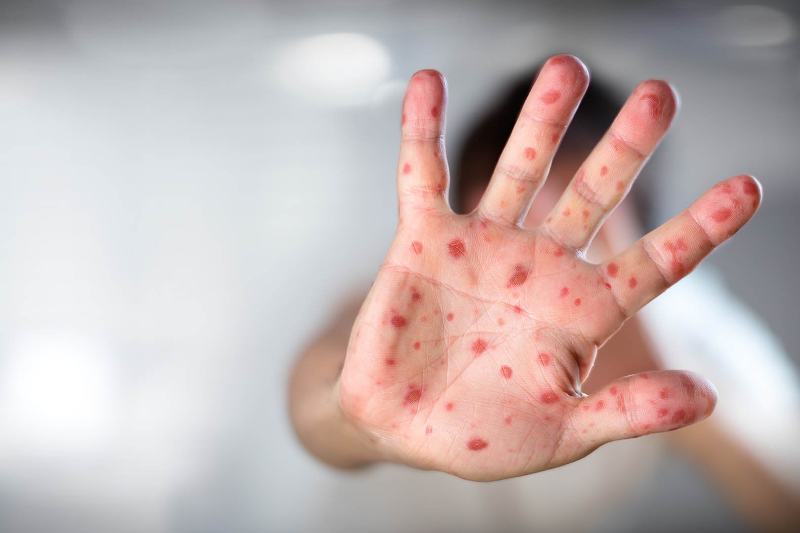 Perbedaan Gejala Flu Biasa vs Flu Singapura